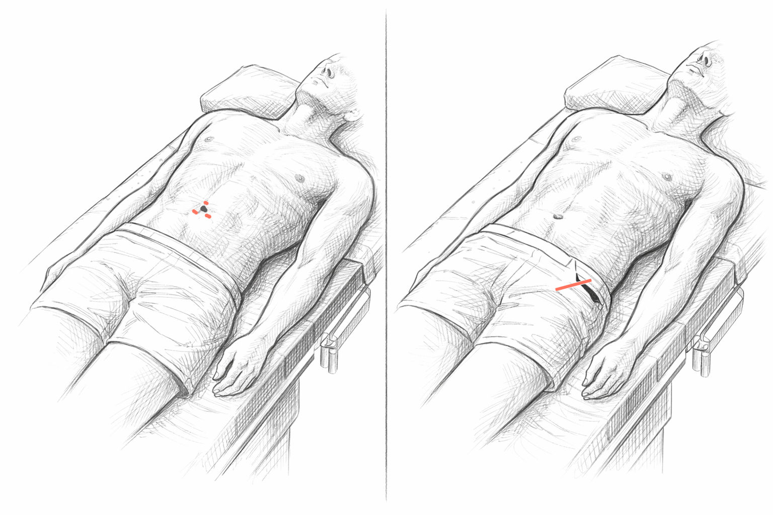 OP-Verfahren bei Leistenhernien